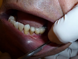 Изберете избелване на зъби 16