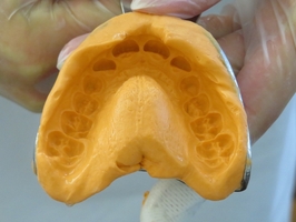 Типове избелване на зъби 30