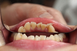 Изберете зъбни импланти 16