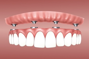 Extremely good Dental Implants 16