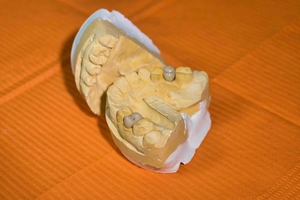 Find the best deals on Dental Implants 33