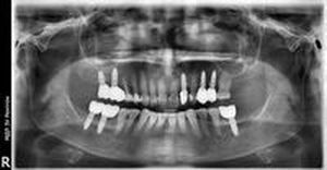 All On 4 - 53783 клиенти | Supreme Dental All On 4 - 87977 клиенти