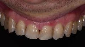 бондинг на зъби - 97929 снимки | Supreme Dental бондинг на зъби - 88260 снимки
